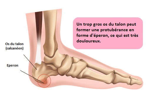 Les causes de la douleur au talon.