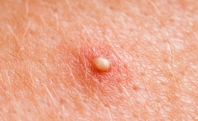 Quelques remèdes maisons contre les furoncles