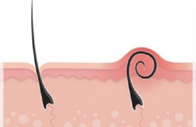 5 conseils pour éliminer les poils incarnés sans douleur