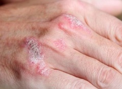 Les nouvelles préparations médicinales selon le traitement du psoriasis