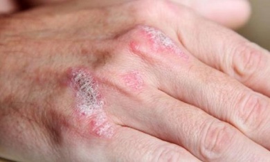 Traitement naturel du psoriasis