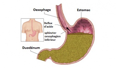 Comment soigner le reflux gastrique