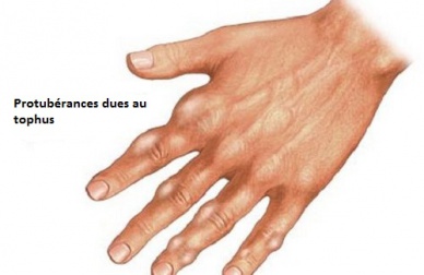 Comment réduire l'acide urique?