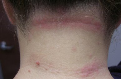 Des remèdes efficaces pour lutter contre la dermite séborrhéique