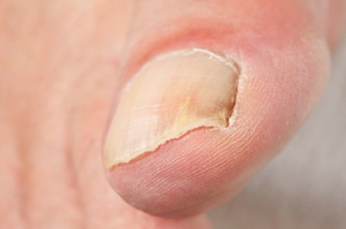 Les changements des ongles sont un signe de ce que nous dit la peau sur notre santé.