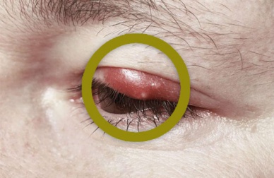 Comment traiter les orgelets à la maison