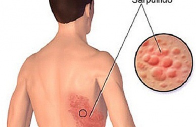 Comment traiter le zona naturellement