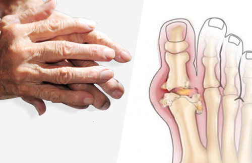 Recommandations pour soulager l’arthrite