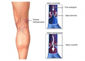 Plantes médicinales pour traiter les varices