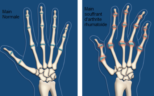 l'arthrite rhumatoide (1)