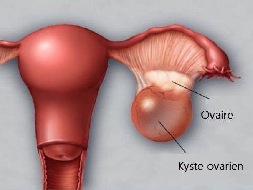 Comment prévenir et détecter à temps les kystes aux ovaires