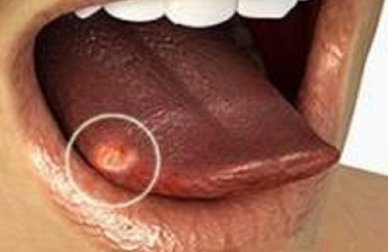 La langue blanche : causes et solutions