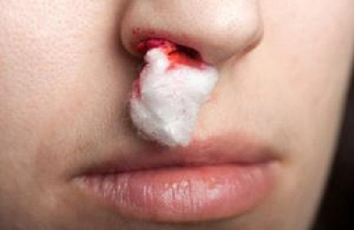 Que faire en cas de saignement de nez