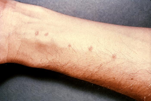traitement maison pour soigner la dermatite