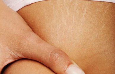 Comment se débarrasser des vergetures