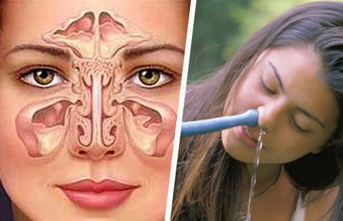 Comment traiter naturellement la sinusite ?