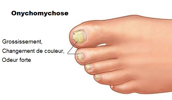 Onychomycose : quand les mycoses affectent les ongles
