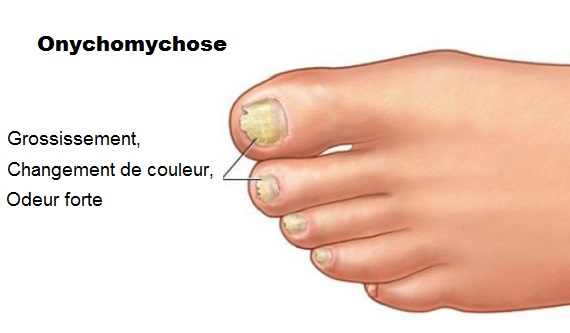 Onychomycose Quand Les Mycoses Affectent Les Ongles