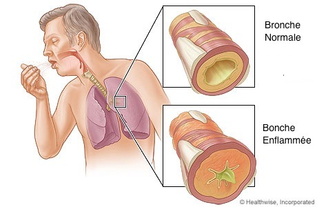 La santé de nos bronches.