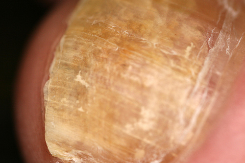 Les mycoses des ongles.