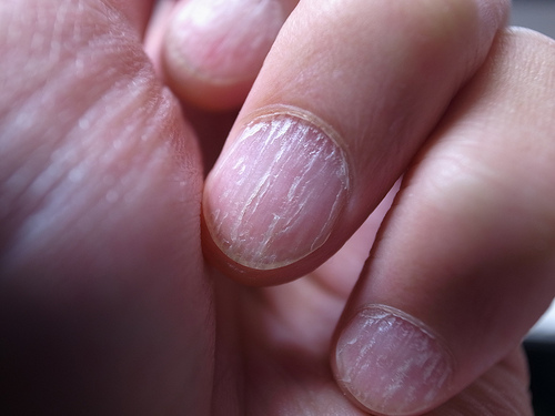 Soigner les mycoses des ongles.