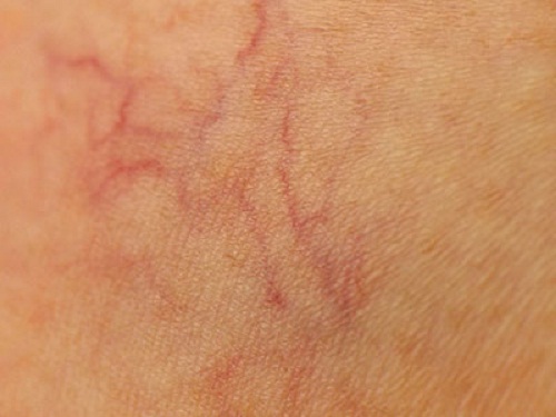 9 conseils pour éviter les « araignées » vasculaires 9 conseils pour éviter les « araignées » vasculaires