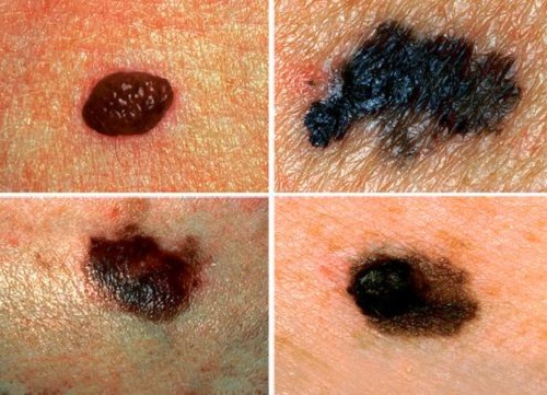 Comment détecter un potentiel cancer de la peau ?