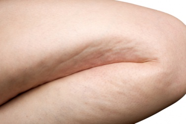 Des conseils et une boisson contre la cellulite