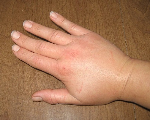 contrôler votre santé avec la rétention d'eau 