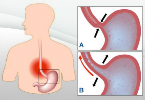 7 remèdes naturels contre l'acidité et le reflux gastrique