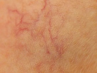 Araignées vasculaires : 9 conseils pour les éviter