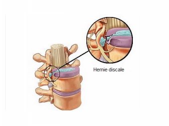 Hernie discale : tout ce que vous devez savoir