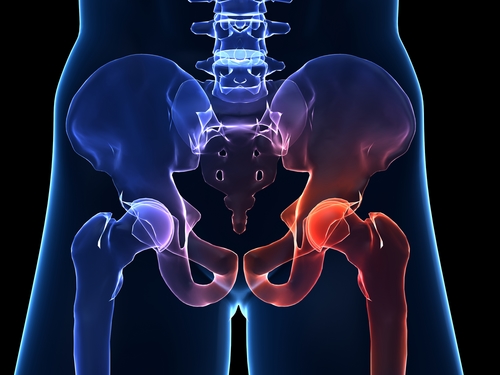 Symptômes et prévention de l'arthrose de hanche