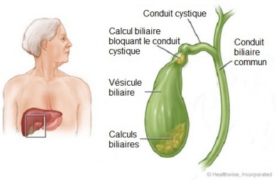 Comment savoir si vous avez des calculs dans la vésicule ?