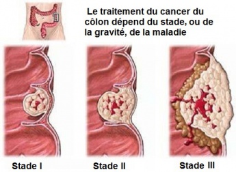 Ce que vous devez savoir sur le cancer du côlon