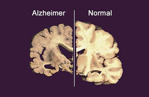 Alzheimer serait lié au manque de sommeil