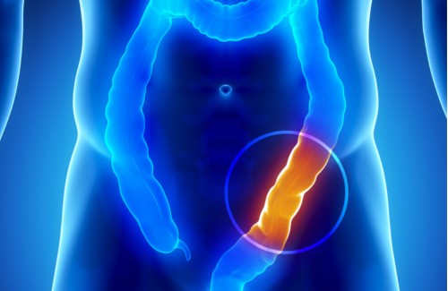 Quels sont les symptômes du cancer du côlon