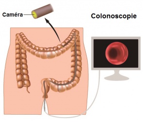 Comment se détecte le cancer du côlon