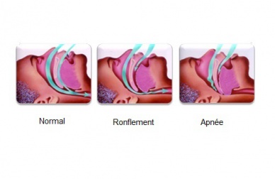 Comment éliminer les ronflements ?
