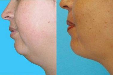 Eliminez votre double menton naturellement et sans chirurgie