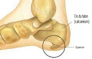 Symptômes et traitements de l'éperon calcanéen