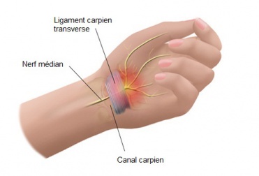 5 remèdes pour atténuer les douleurs du syndrome du canal carpien