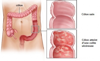 Traitements maison contre la colite ulcéreuse