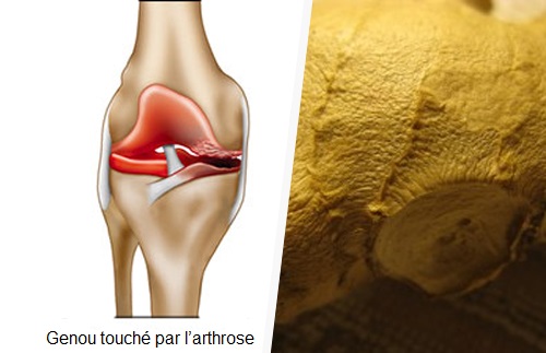 Comment soulager les symptômes de l’arthrose Comment soulager les symptômes de l’arthrose
