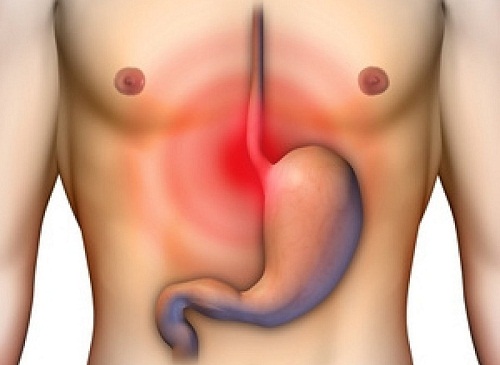Brûlures d'estomac ou d'acidité gastrique? Ce sont deux choses différentes !