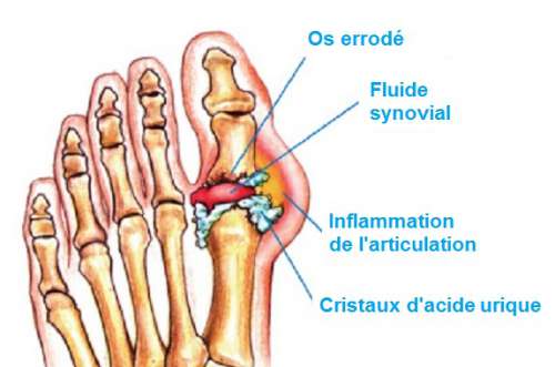 Comment éliminer naturellement les cristaux d’acide urique dans les articulations ? Comment éliminer naturellement les cristaux d’acide urique dans les articulations ?