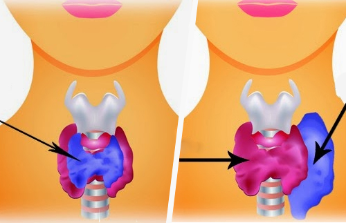 Connaissez-vous la différence entre l’hypothyroïdie et l’hyperthyroïdie ? Connaissez-vous la différence entre l’hypothyroïdie et l’hyperthyroïdie ?