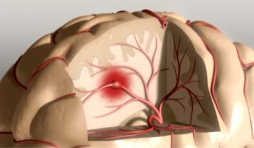 conséquences du manque de sommeil sur le cerveau