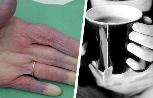 Vous avez les mains froides ? Découvrez pourquoi !