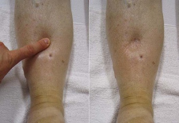 Hydropisie : quelles en sont les causes ?